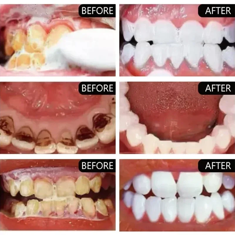 Fast Remove Smoke Stains Tooth - Teeth Whitening Fast avaliação e preço