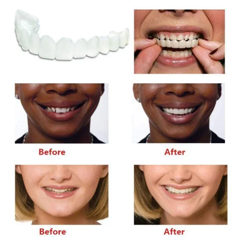 Denture Cover Veneer Snap-on T - Teeth Whitening Session avaliação e preço