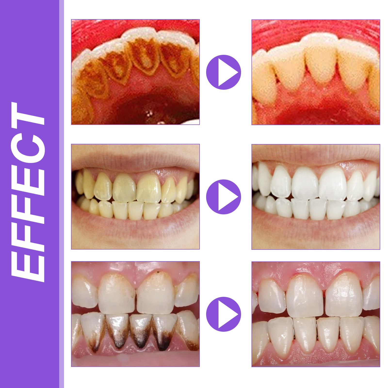 EELHOE Smiles Bright White Ref - Teeth Whitening Best avaliação e preço
