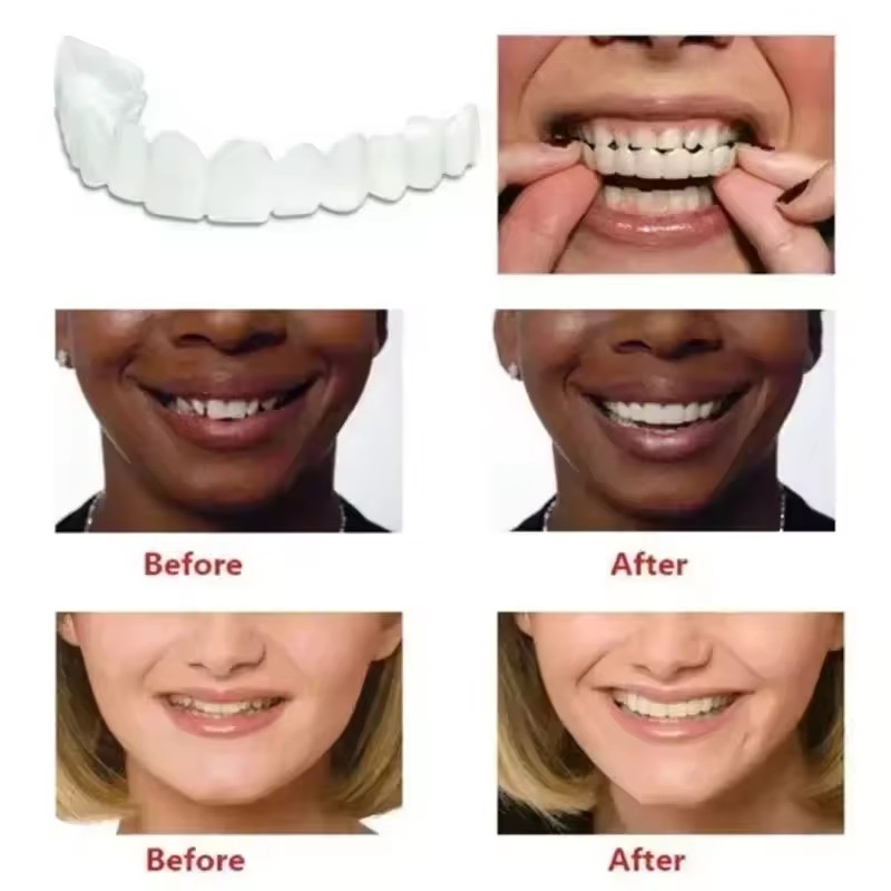 Teeth Veneers Whitening Dentur - Teeth Whitening Session avaliação e preço