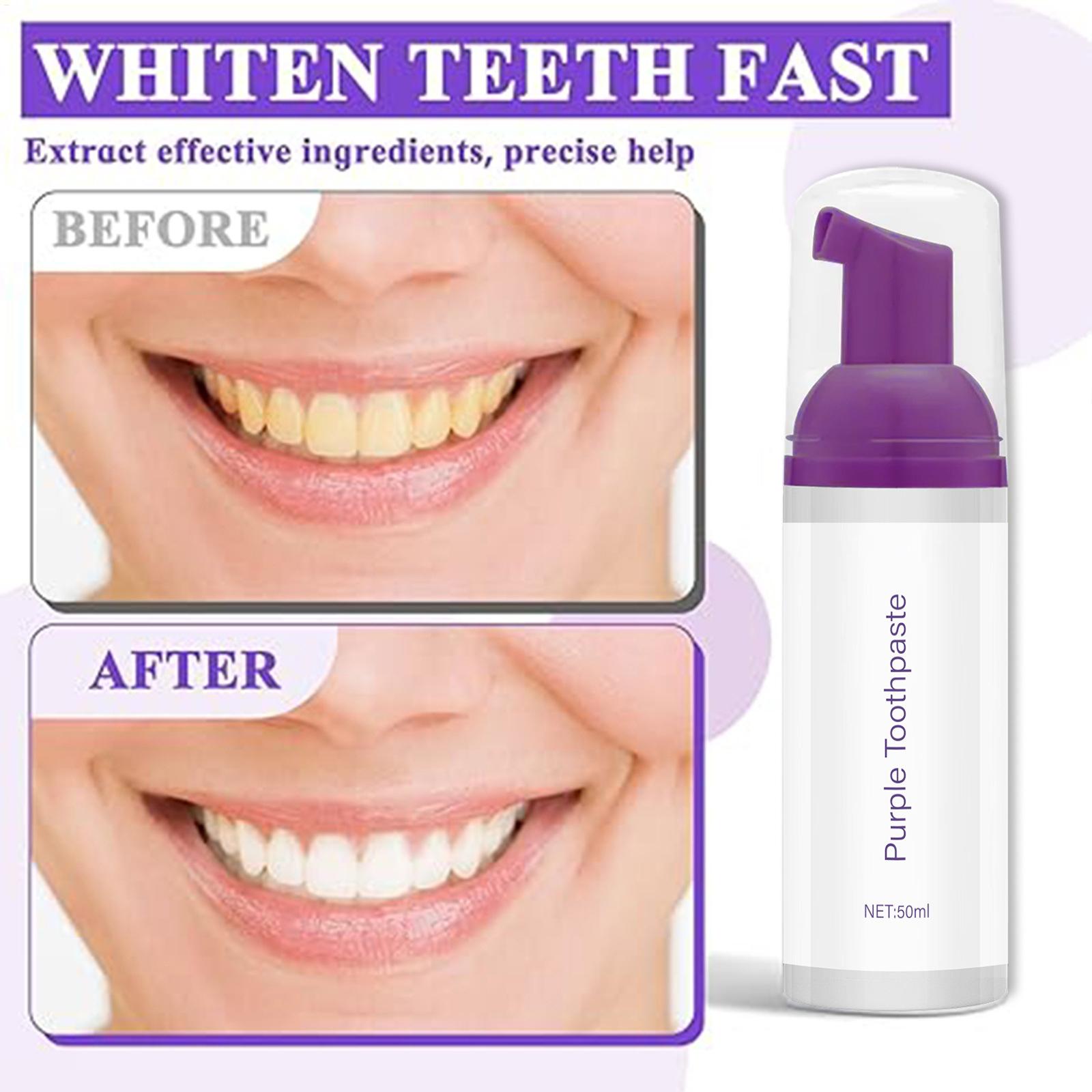 Mousse Toothpaste 50ml Brighte - Teeth Whitening Before And After avaliação e preço