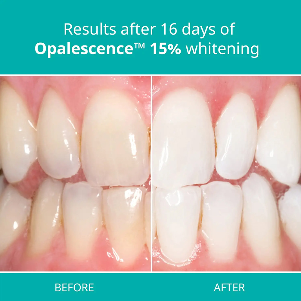 opalescence pf 15% refill kit  - Teeth Whitening Gel Opalescence avaliação e preço