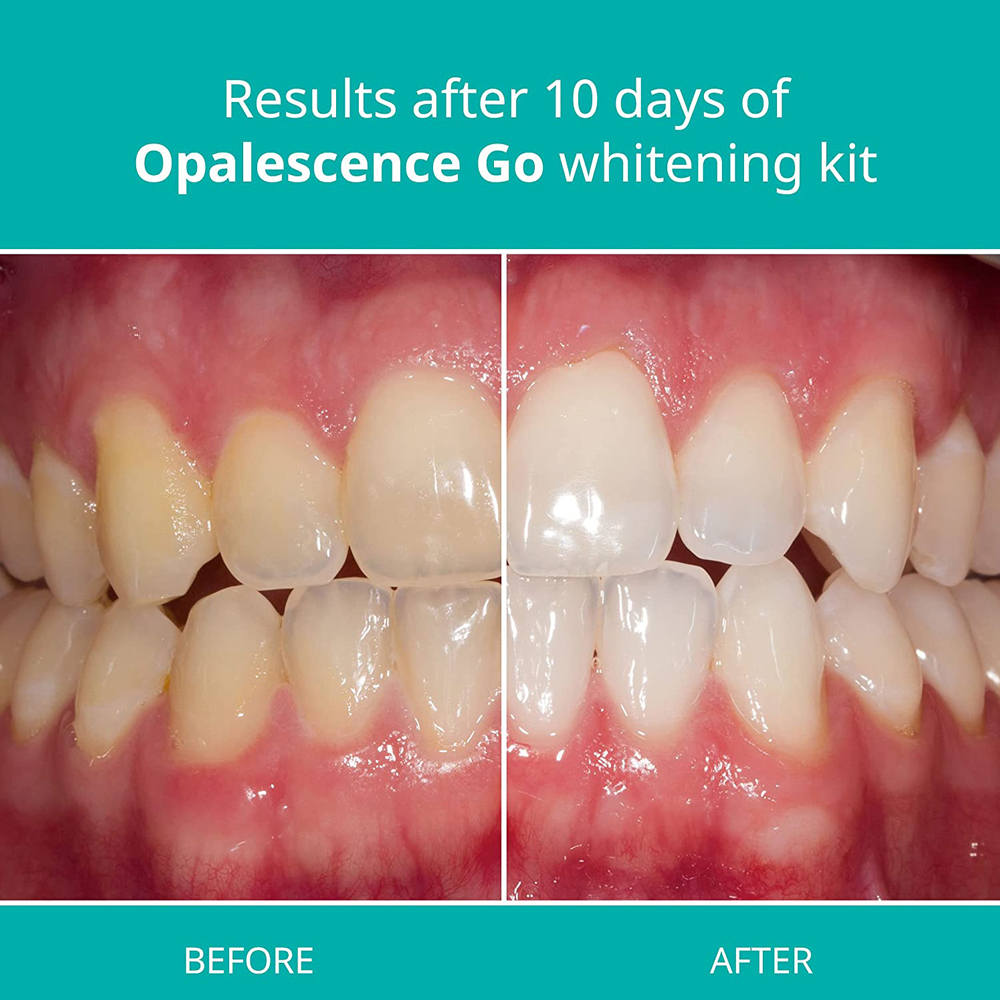 Opalescence Go Teeth Whitening - Teeth Whitening Gel Opalescence avaliação e preço