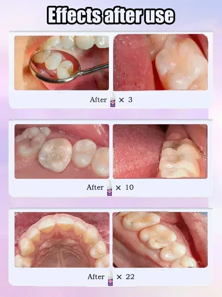 Teeth Cleaning Toothpaste Remo - Teeth Whitening Best avaliação e preço